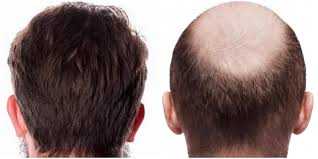 hair transplant