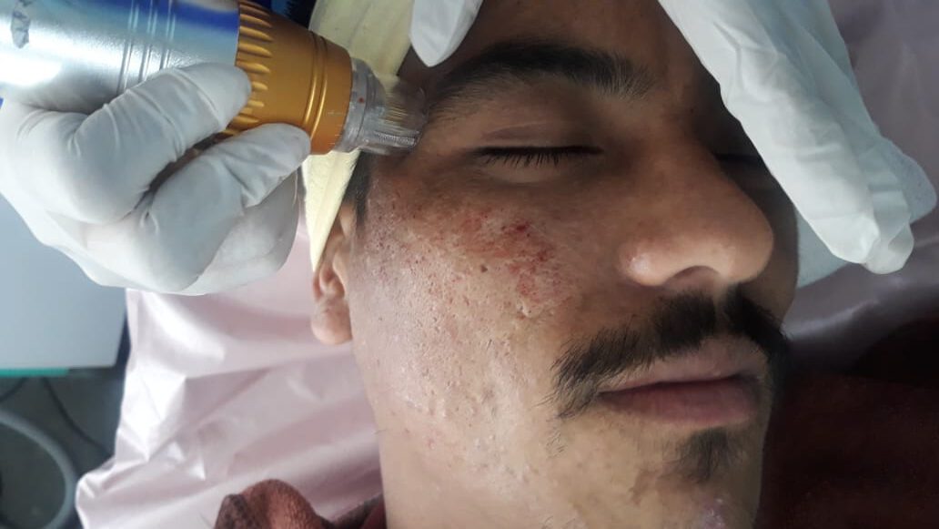 Acne Scar Treatment in Nepal