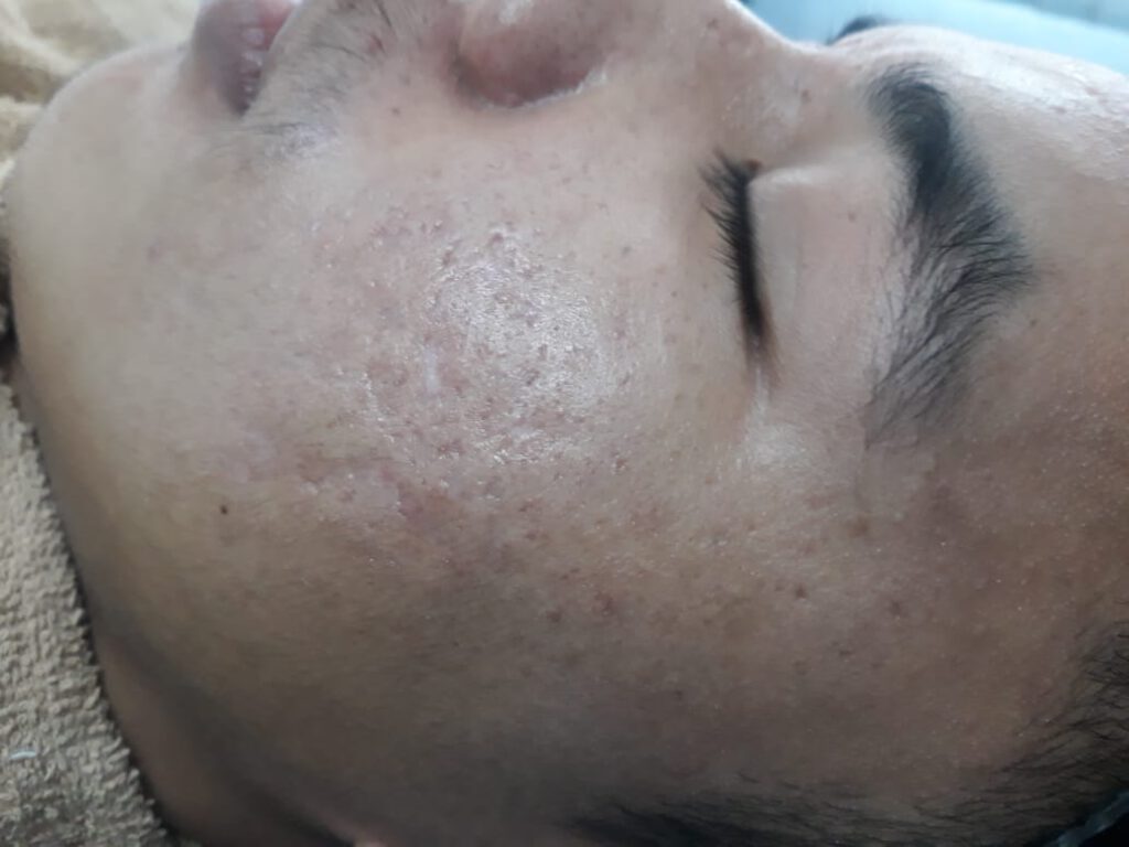 How to get rid of acne scars in Kathmandu, Nepal