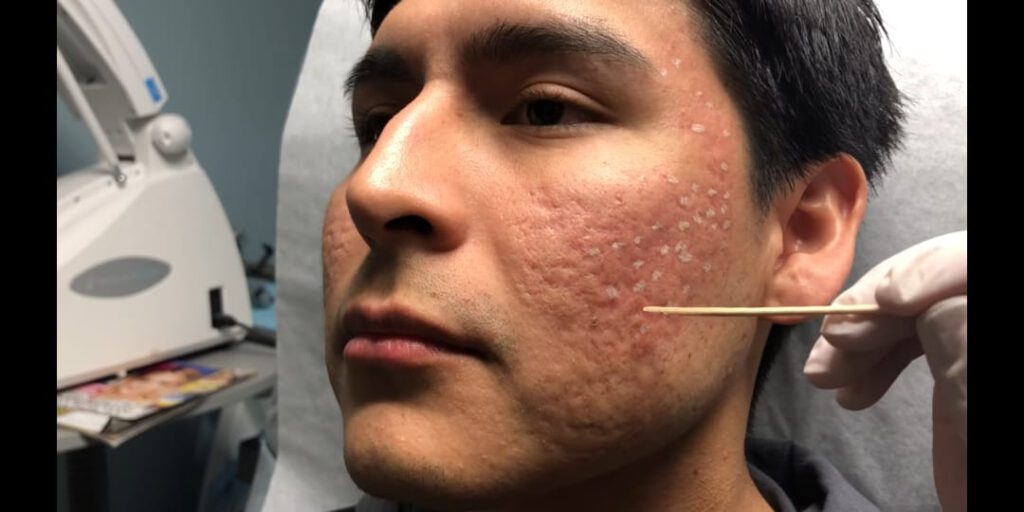 TCA Cross for acne scar removal in Nepal Price