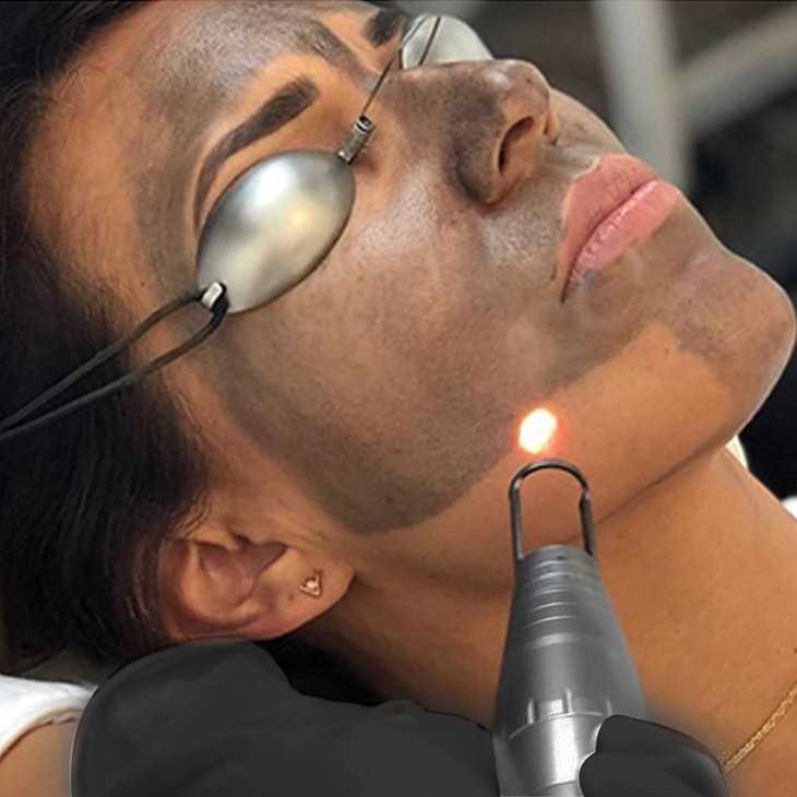 charcoal laser facial in Nepal