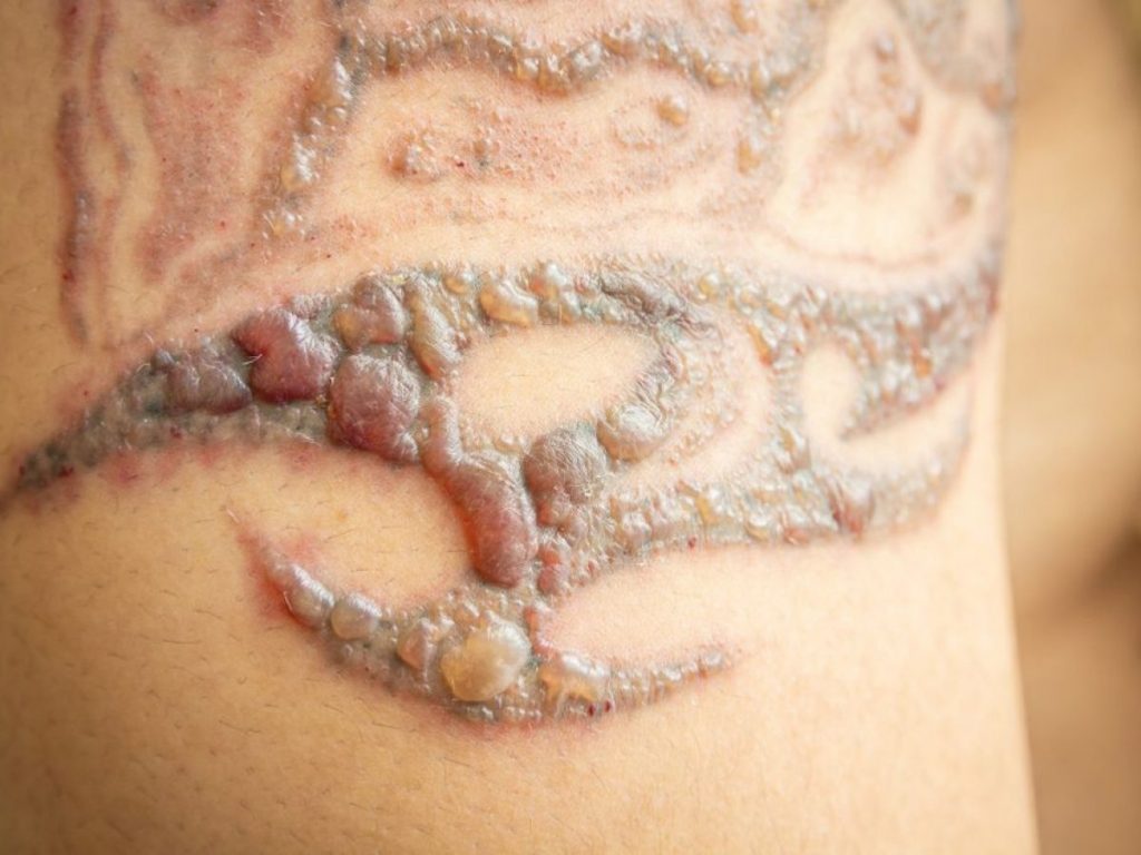 laser tattoo removal side effects