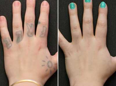 laser tattoo removal before after