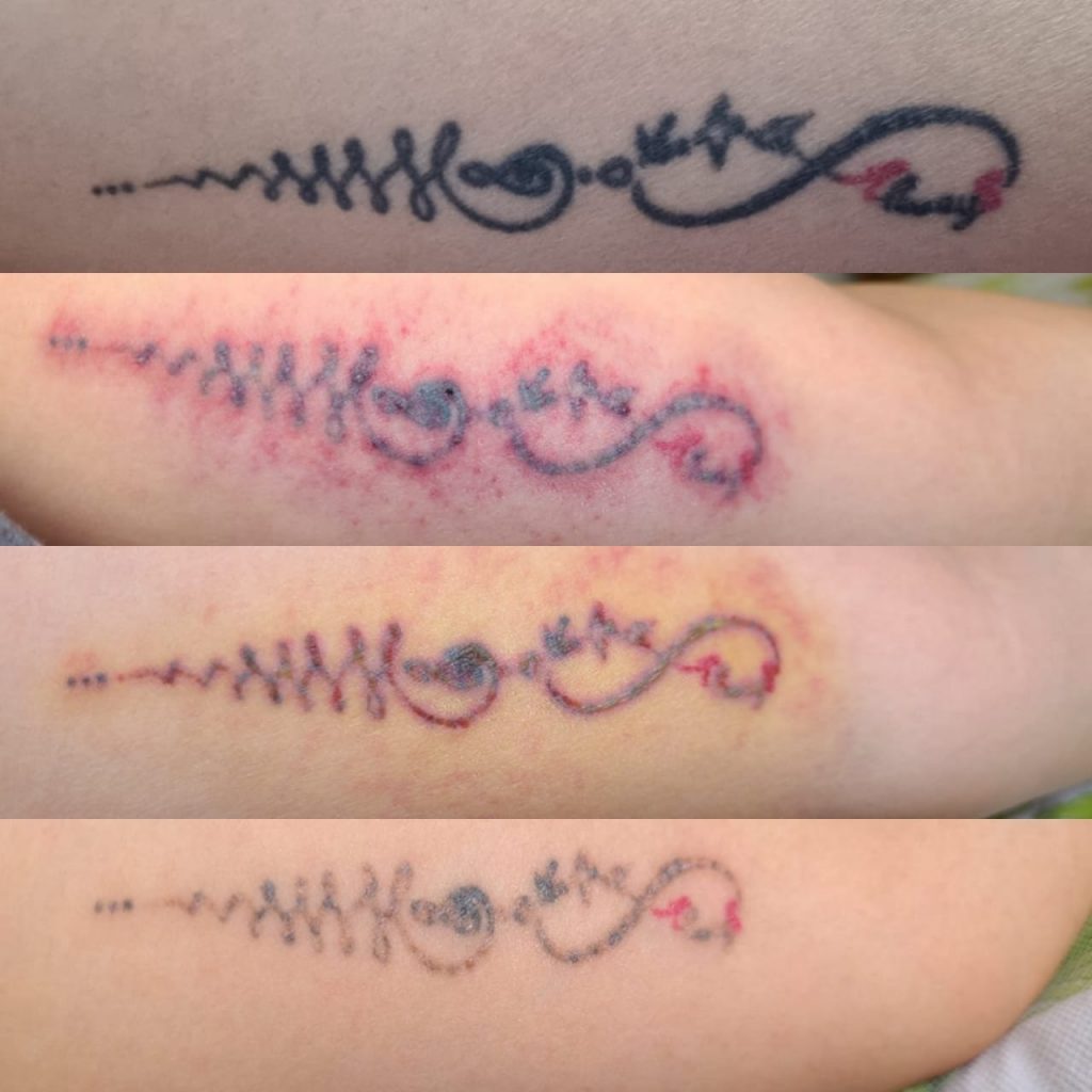 laser tattoo removal in multiple sessions