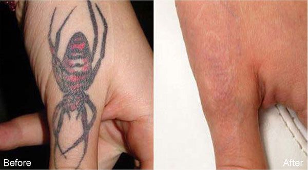 laser tattoo removal before after