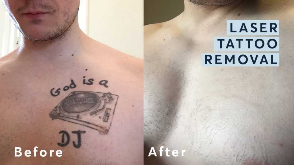 laser tattoo removal before after