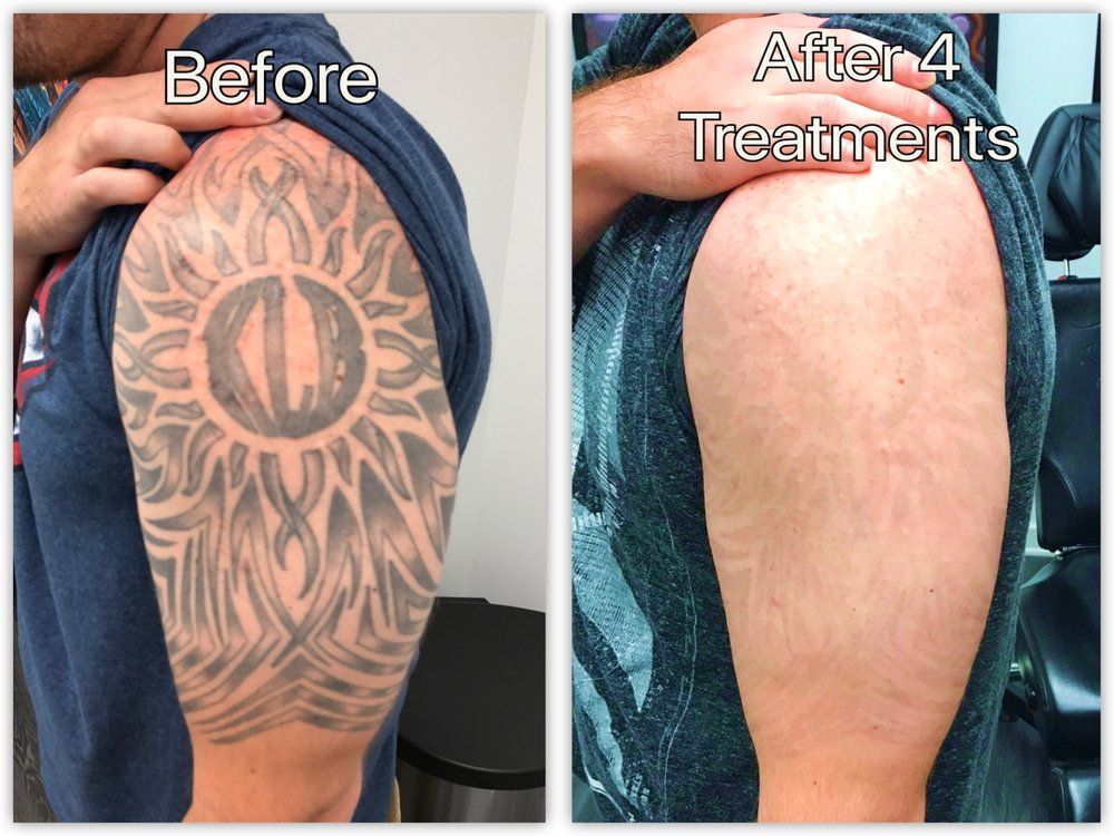 Tatoo Removal Before And After