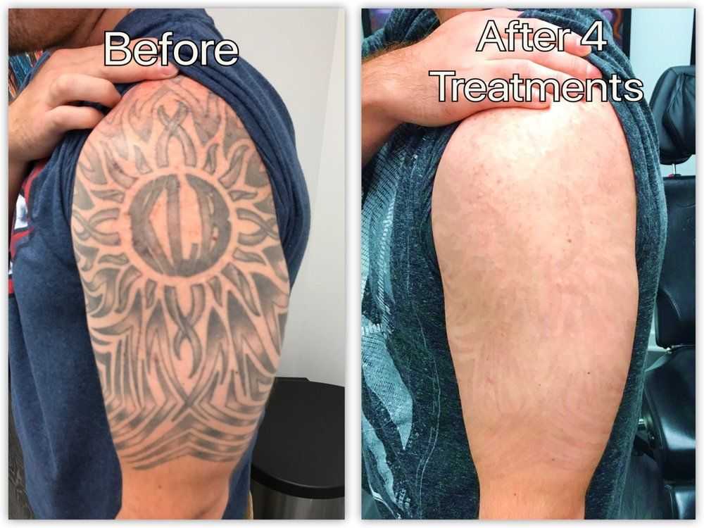 5. Laser Tattoo Removal Specialists in Philadelphia - wide 6