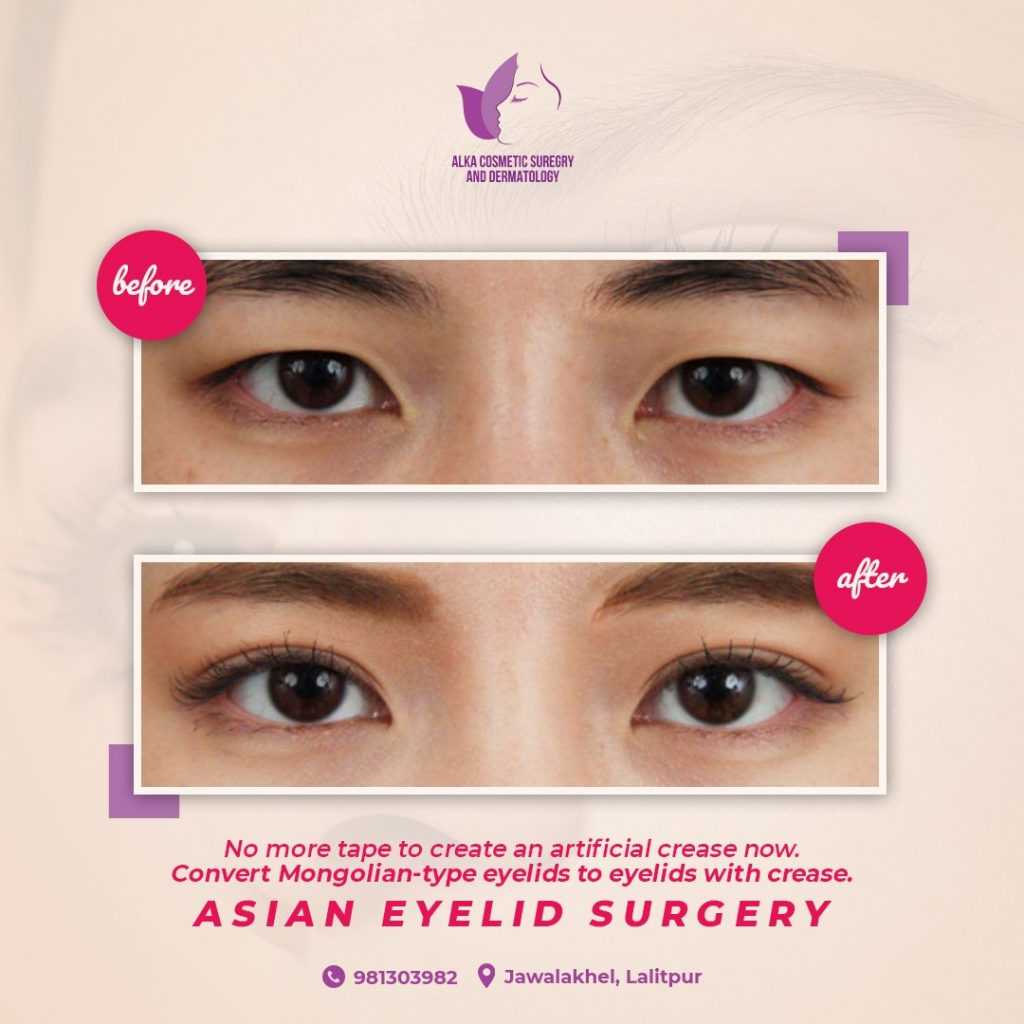 Asian Eyelid Surgery in Kathmandu, Nepal