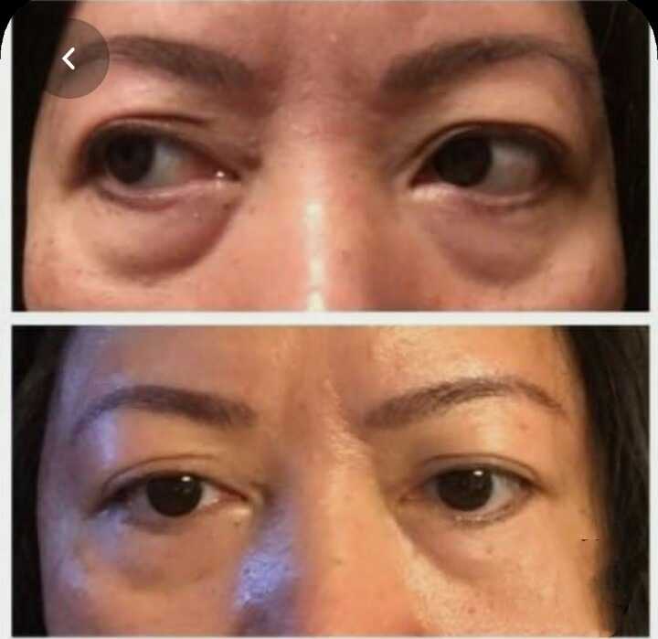 Lower Eyelid Lower Eyelid Blepharoplasty