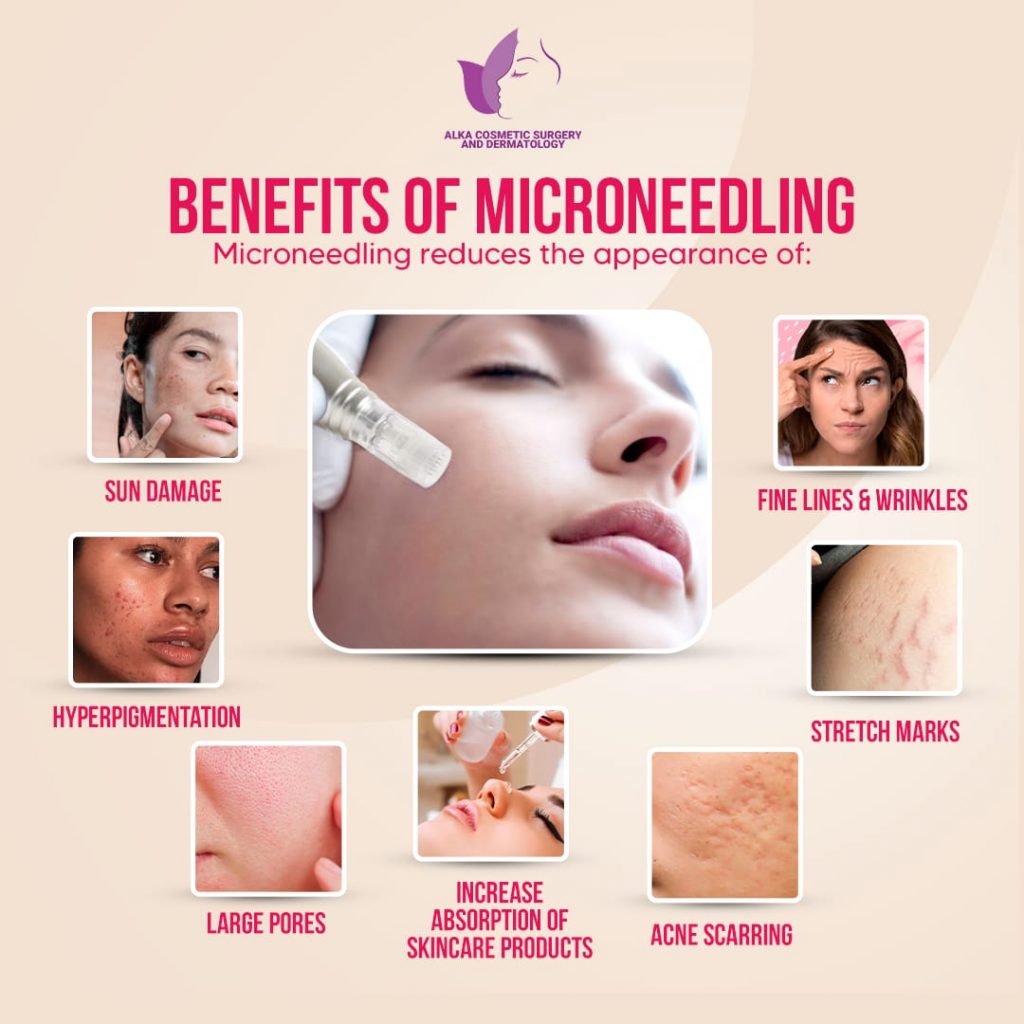benefits of vampire facial (microneedling)